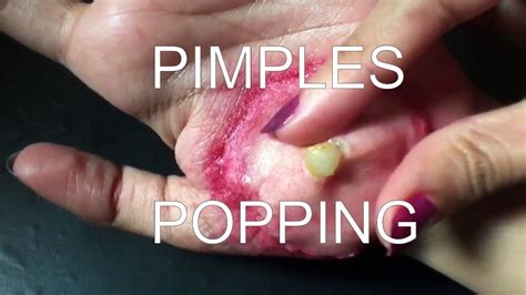 A retired firefighter gets the Dr. . Youtube popping pimples